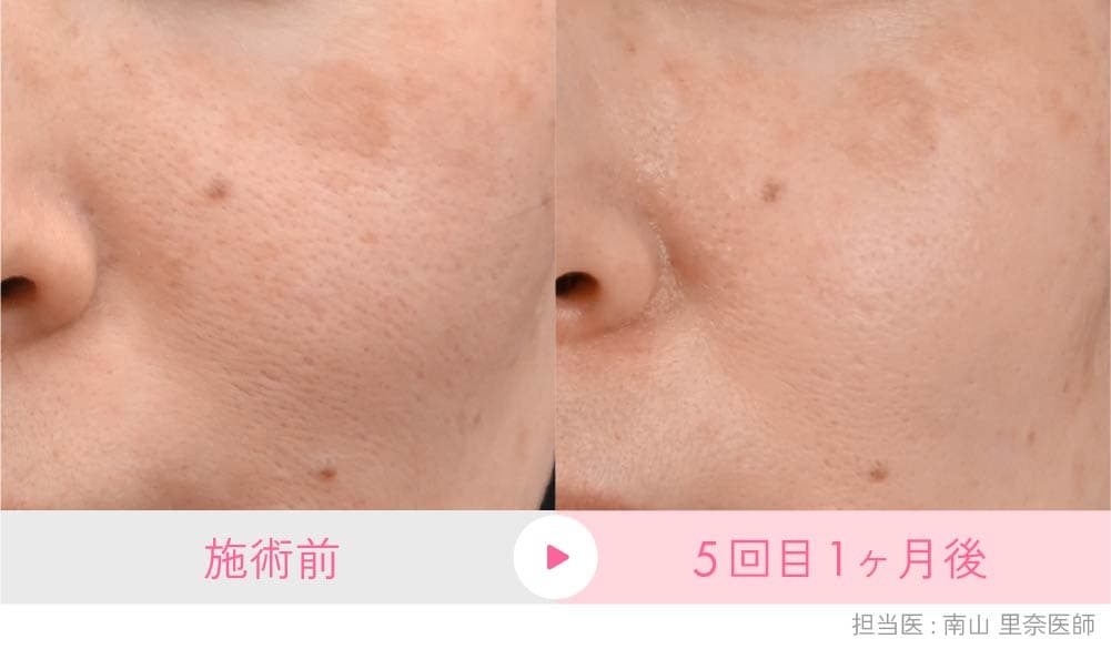 京都院のシルファームX症例:皮膚が内側から引き締まりたるみ毛穴が改善