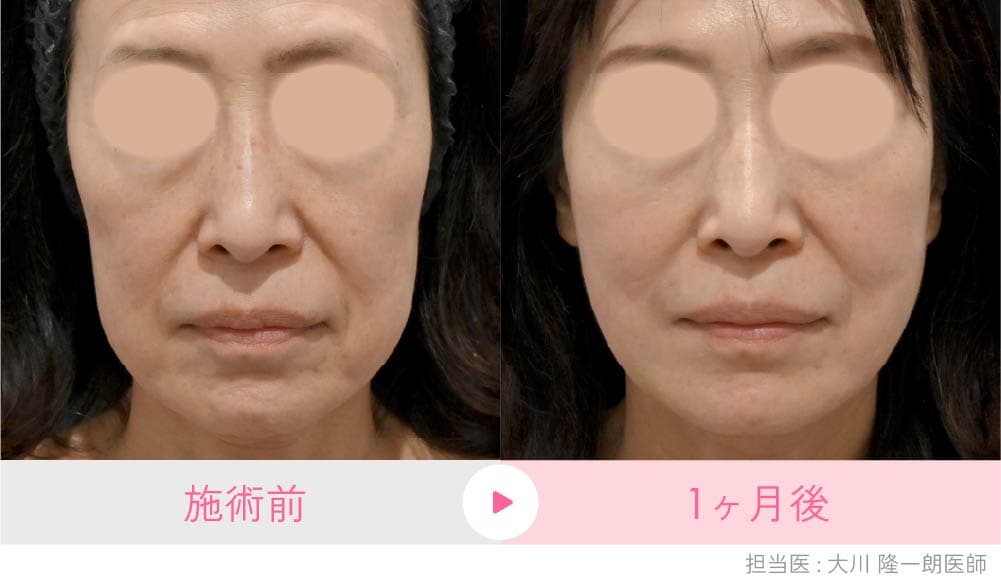 京都院のプロファイロ×糸リフト症例:輪郭のたるみを引き上げ、肌を引き締めハリ感を改善