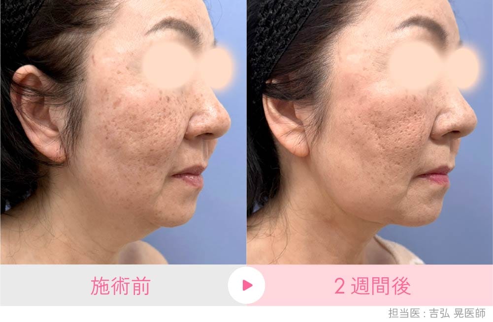 京都院の糸リフト症例(50代女性):たるみでぼやけていたフェイスラインがくっきりと引き上がり改善