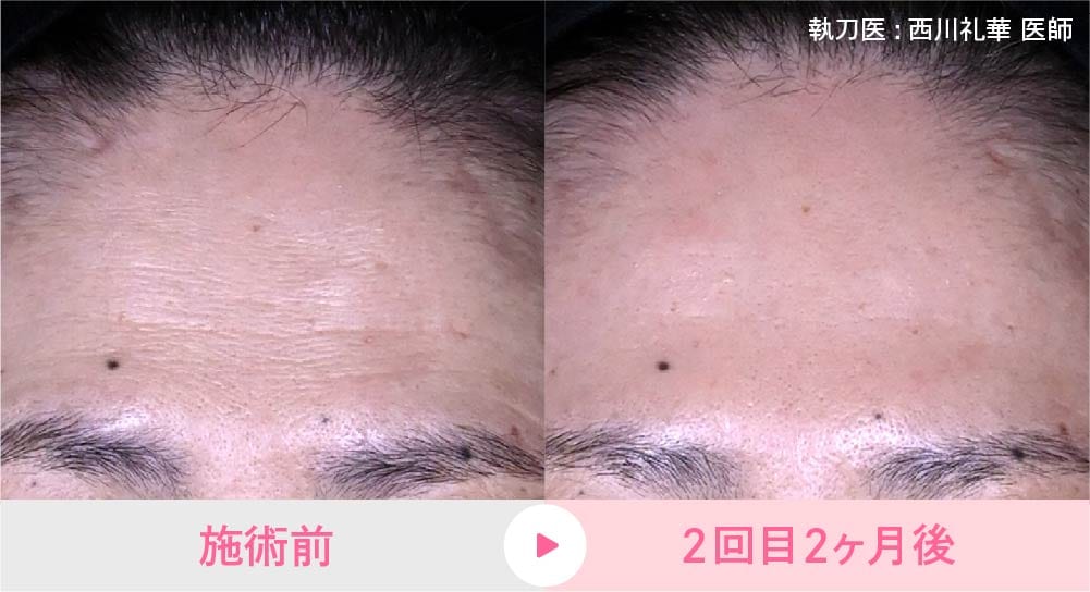 女優注射の症例写真1