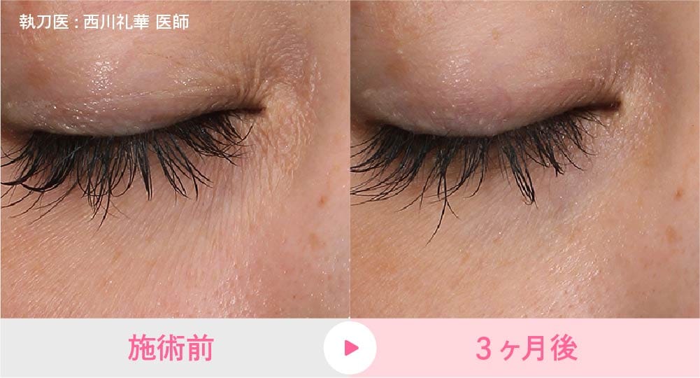 女優注射の症例写真2