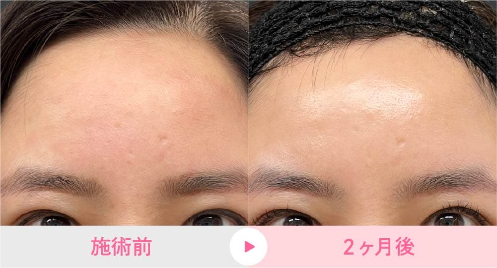 スタッフAのリジュランi(額・こめかみ)術前・2ヶ月後の症例