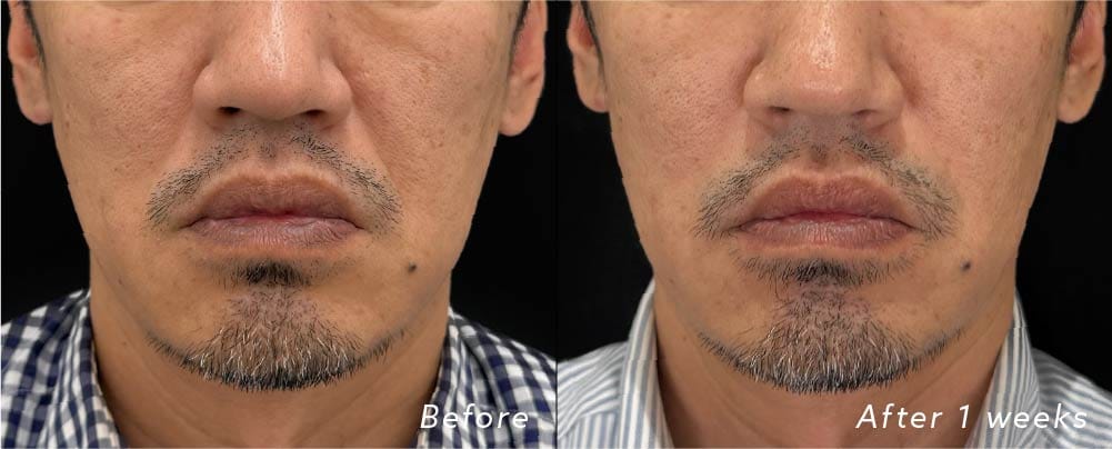40代男性の糸リフト+ほうれい線ヒアルロン酸症例