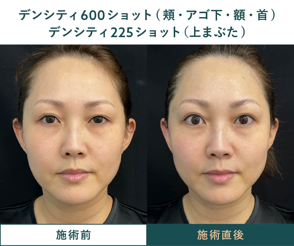 30代女性のデンシティ照射直後の症例写真｜顔全体のたるみ・口横のもたつき改善