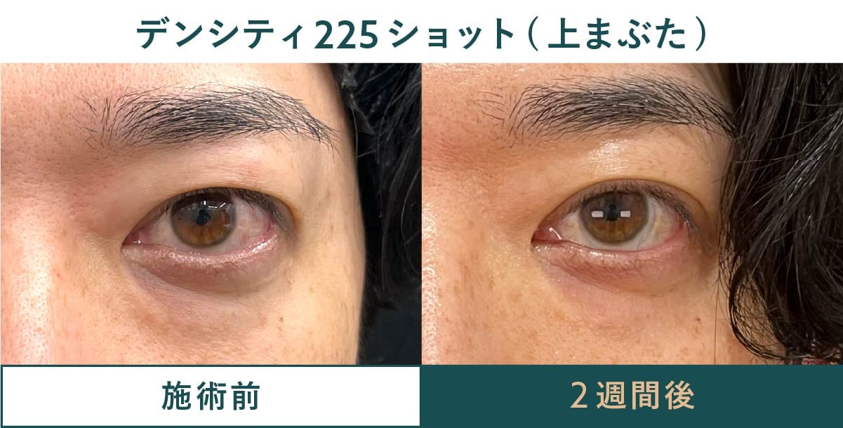 デンシティアイによる上まぶたのたるみ引き上げ症例（目元専用ハイフとの比較にも）