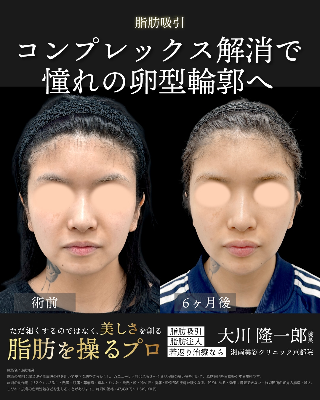 ベイザー脂肪吸引(ほほ＋アゴ下)＋ジョールファット除去＋プリマリフト8本＋ヒアルロン酸(顎)＋ボトックス(顎)