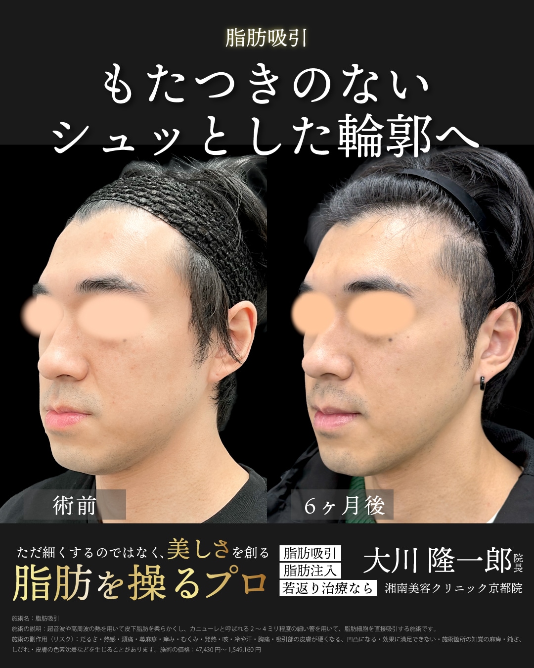 ベイザー脂肪吸引(ほほ＋アゴ下)＋ジョールファット除去