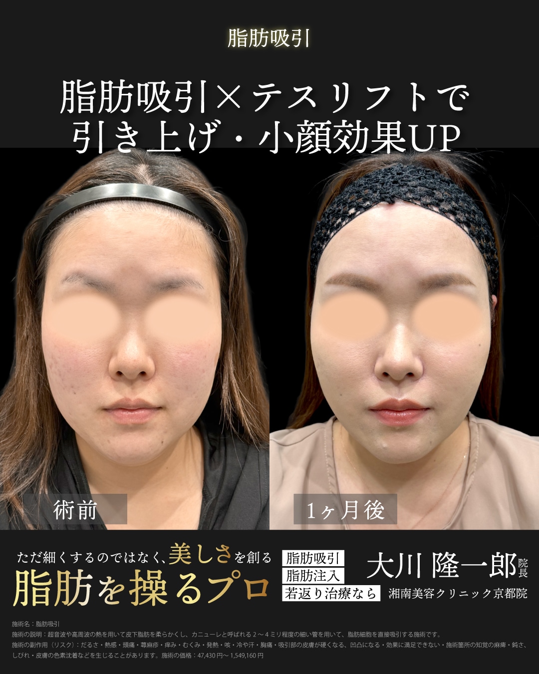 ベイザー脂肪吸引(ほほ＋アゴ下)＋ジョールファット除去＋テスリフト14本