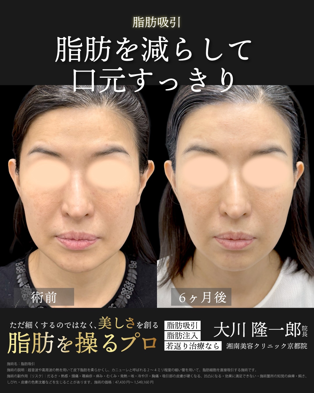 ベイザー脂肪吸引(ほほ)＋ジョールファット除去＋シークレットリフト4本＋テスリフト4本＋ナチュラル脂肪注射(頬＋額＋こめかみ)