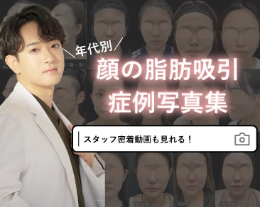 【顔の脂肪吸引】年代別症例まとめ