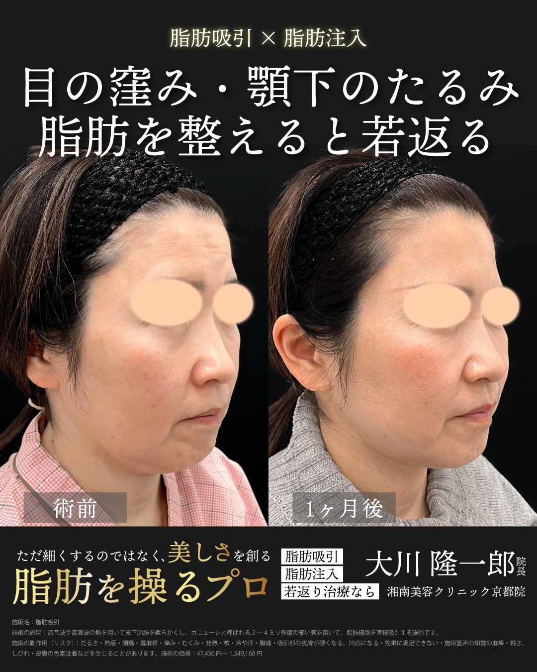 ベイザー脂肪吸引(アゴ下)＋脂肪吸引注射(頬)＋ジョールファット除去＋VOVリフト4本＋ナチュラル脂肪注射コンデンスリッチ(目の下)＋ナチュラル脂肪注射ナノリッチ(目の下)