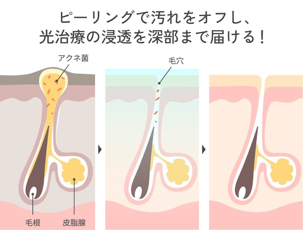 アクネライト×ララドクターのイメージ