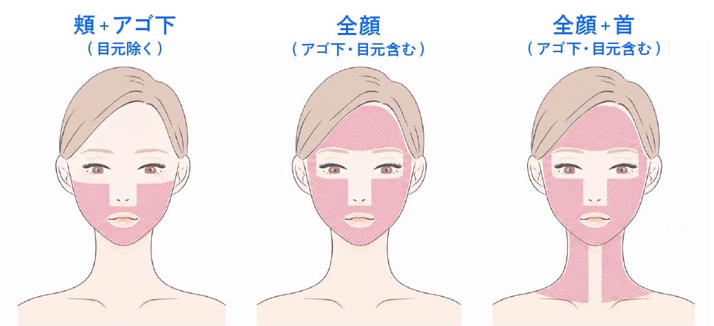SBCハイフプログラムの照射範囲