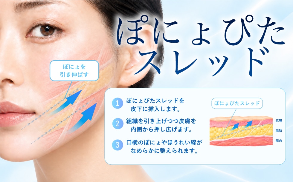 ぽにょぴたスレッドのメカニズム