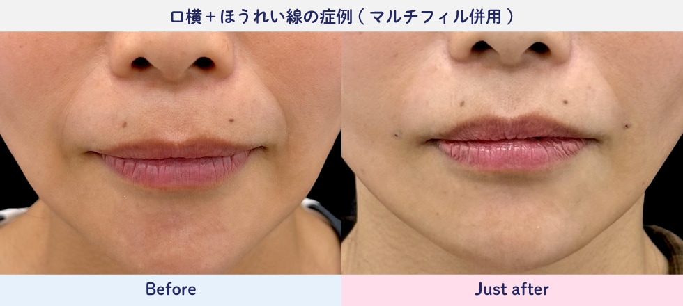 ぽにょぴたスレッド+マルチフィル症例写真