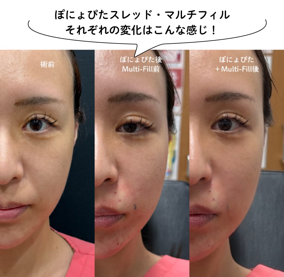 ぽにょぴたとマルチフィルそれぞれの効果
