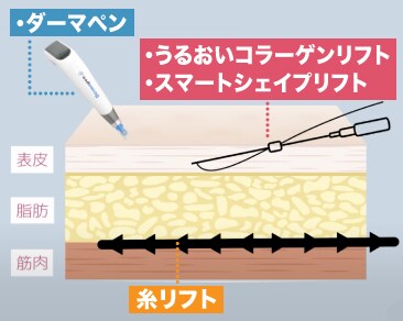 「糸リフト」と「美容針」の違いは？