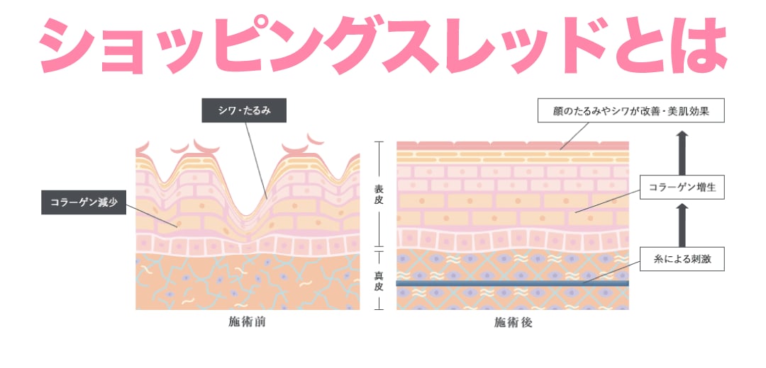 ショッピングスレッドリフト（美容針）とは？