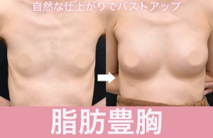 「豊胸」モニター募集