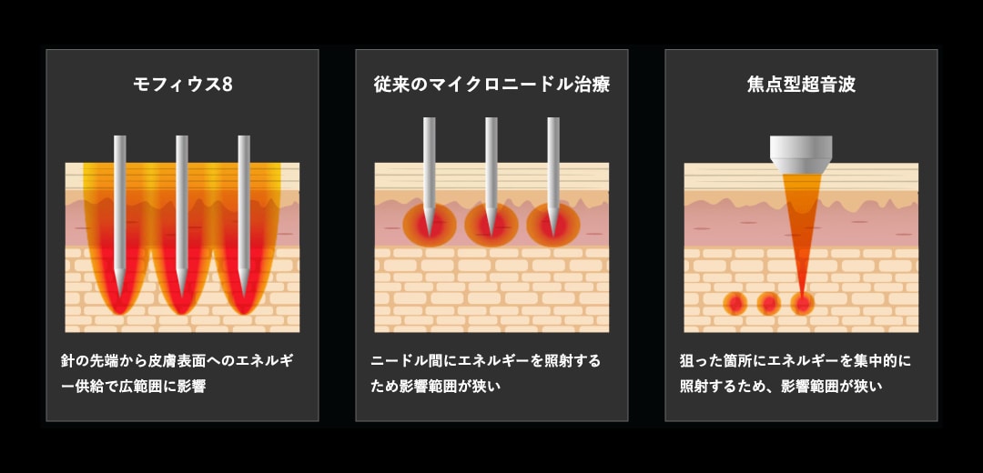 モフィウス8の仕組みとは？