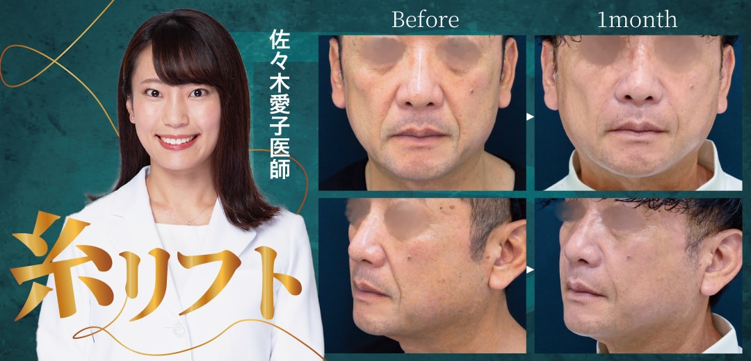 糸リフト