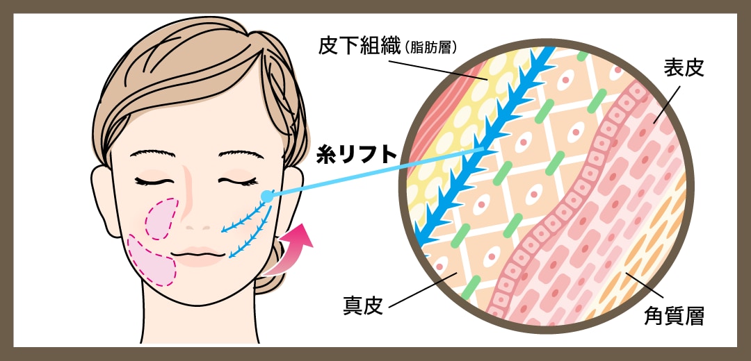 糸リフトの効果