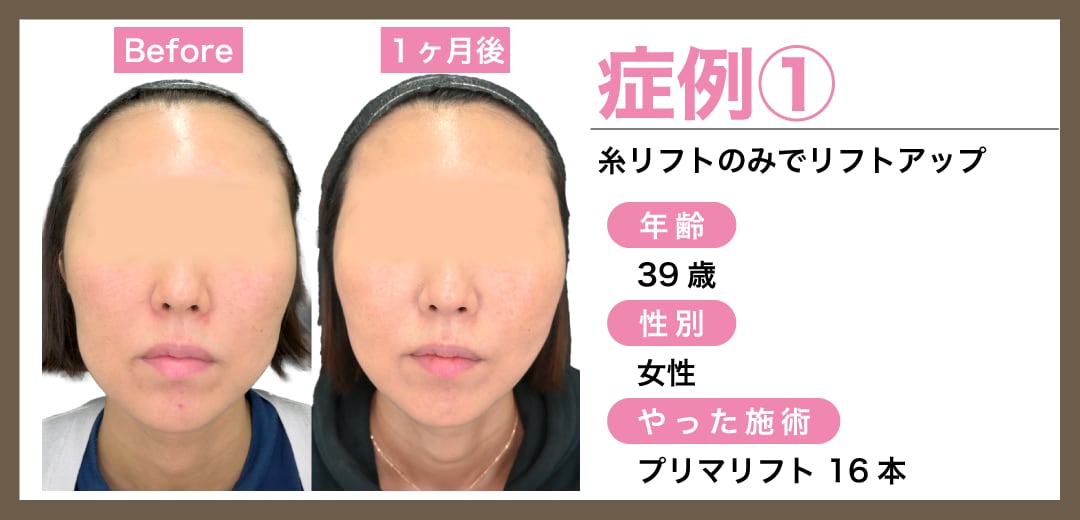 症例1:糸リフトのみ