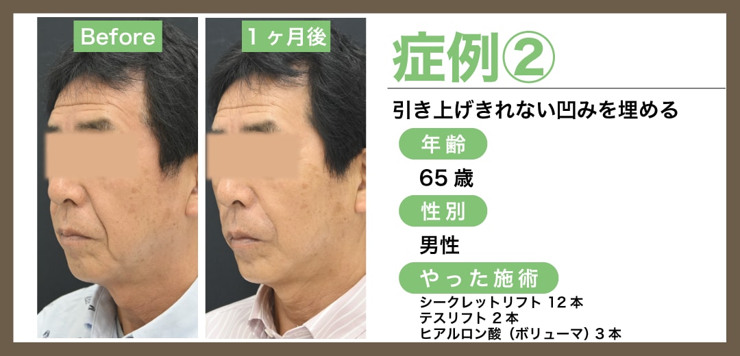 症例2:糸リフト+ヒアルロン酸