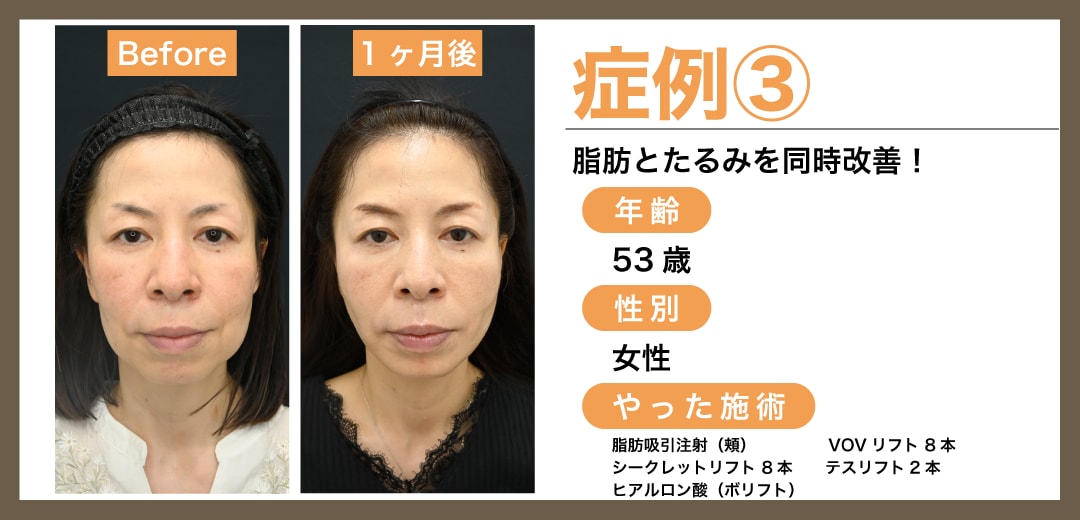 症例3:糸リフト+脂肪吸引(脂肪吸引注射)