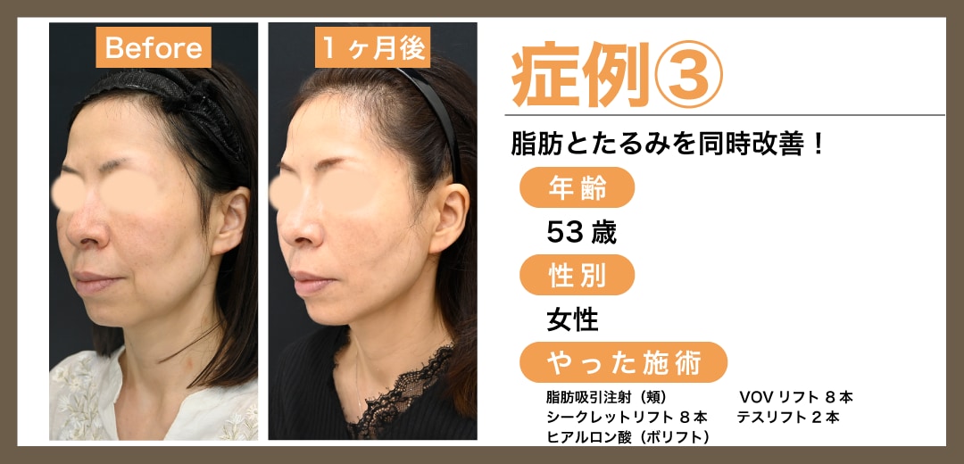 症例3：糸リフト＋脂肪吸引（脂肪吸引注射）