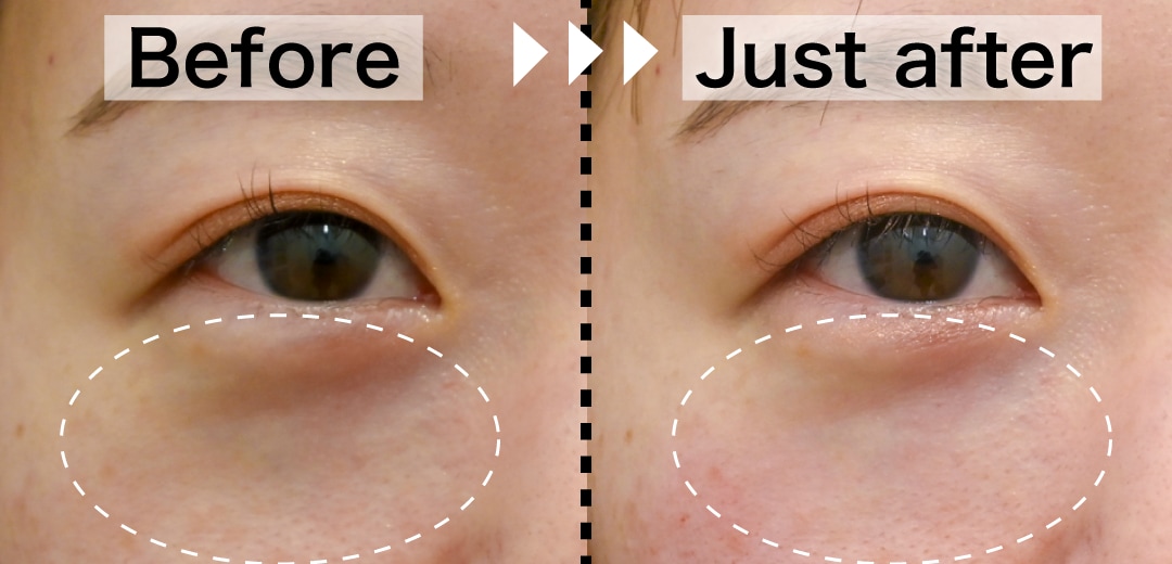 目の下のクマが気になるところに！<br />
ベビーコラーゲンを打ちました！💉