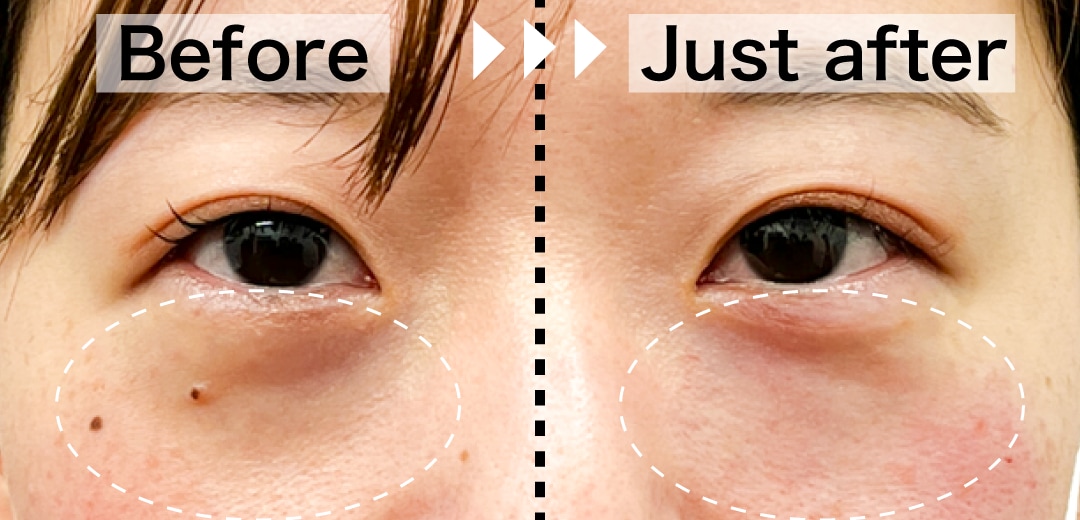 目の下のクマが気になるところに！<br />
ベビーコラーゲンを打ちました！💉