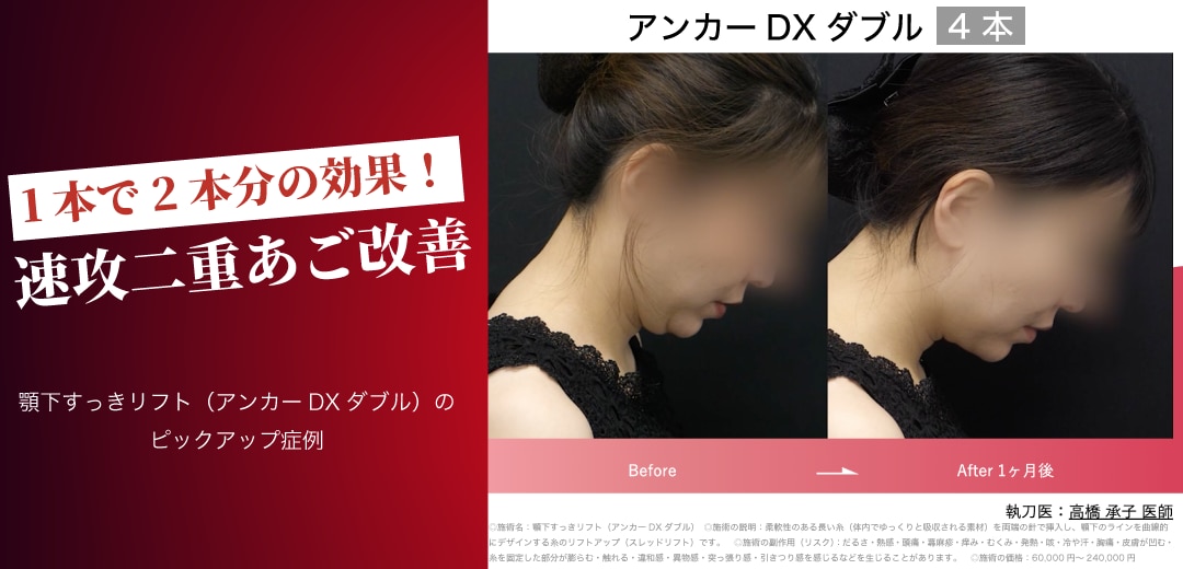 顎下すっきリフト（アンカーDXダブル）とは