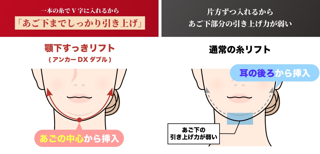 従来の糸リフトとの違い