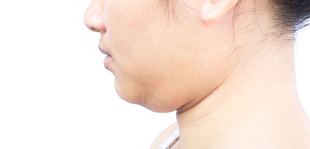 二重あごの改善に特化