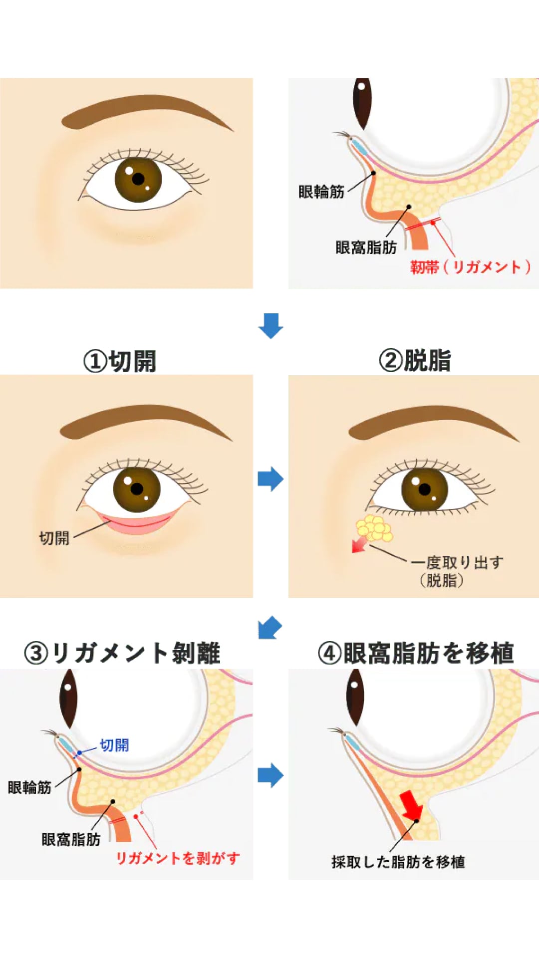 ミニ裏ハムラ法とは