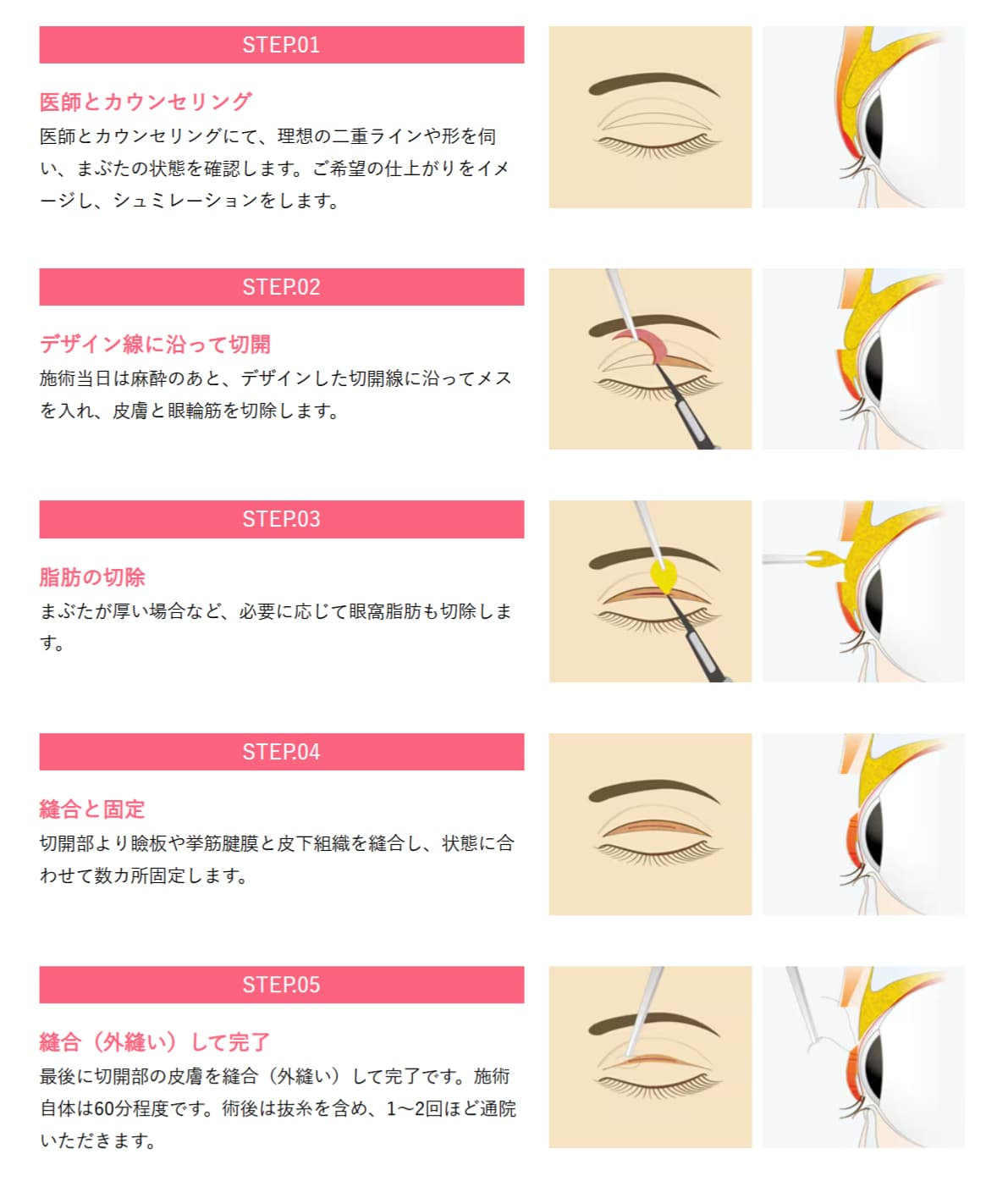 ▶ 切開法<br />
まぶたを切開してラインをつくる方法