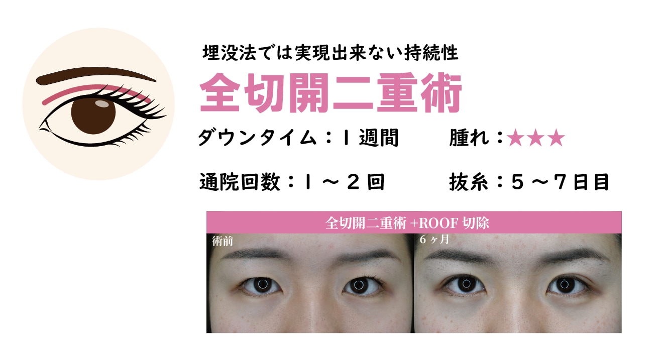 全切開二重術