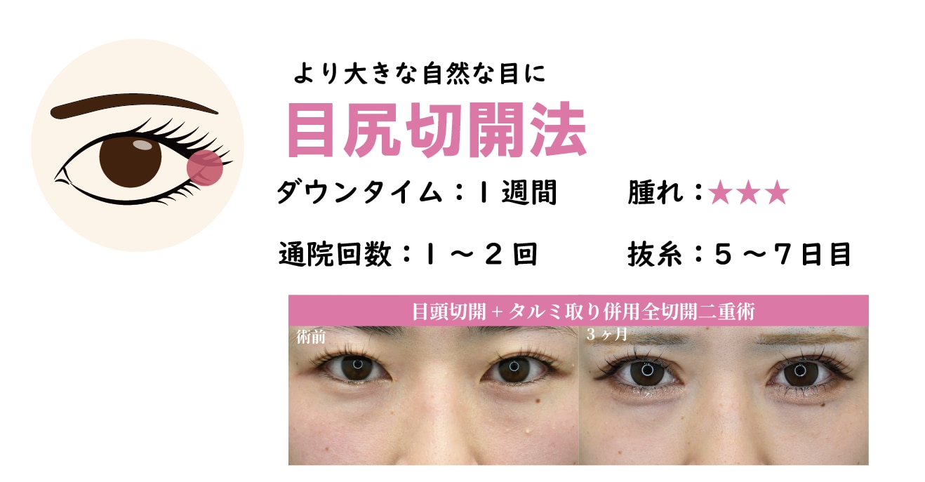 目尻切開法