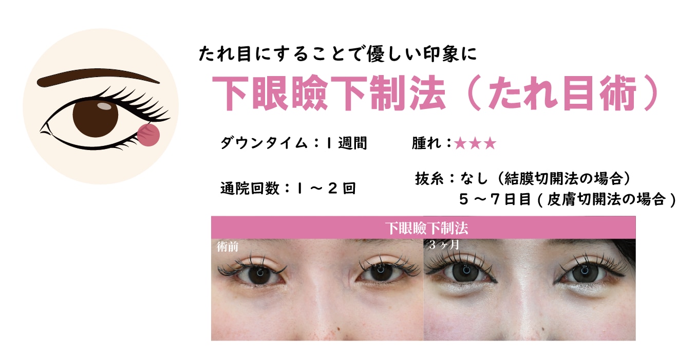 下眼瞼下制法