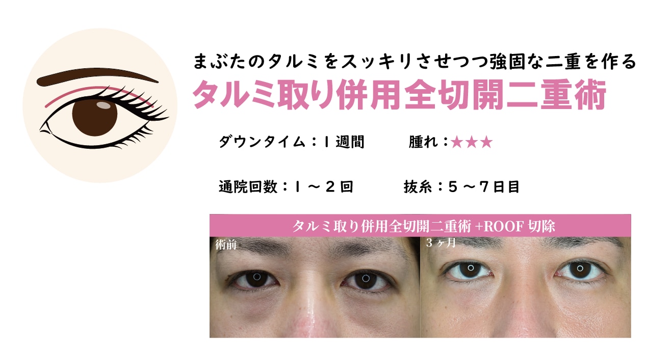 タルミ取り併用全切開二重術