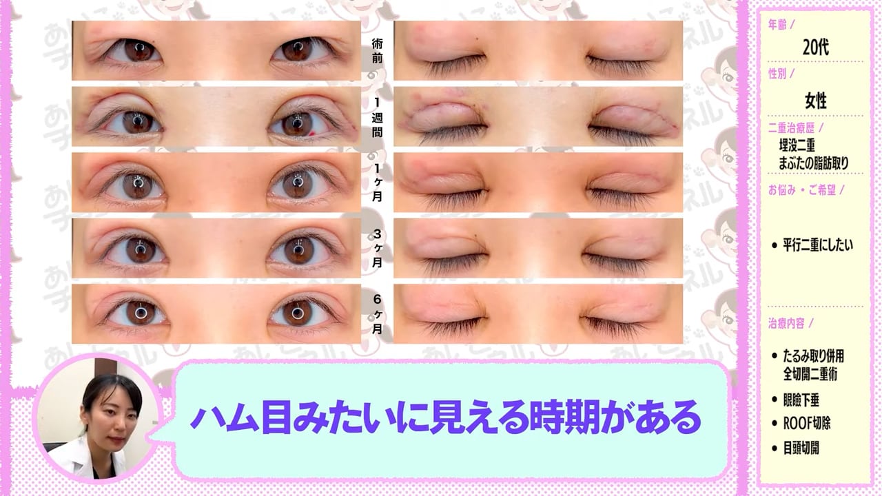 食い込みが激しい「ハム目」状態