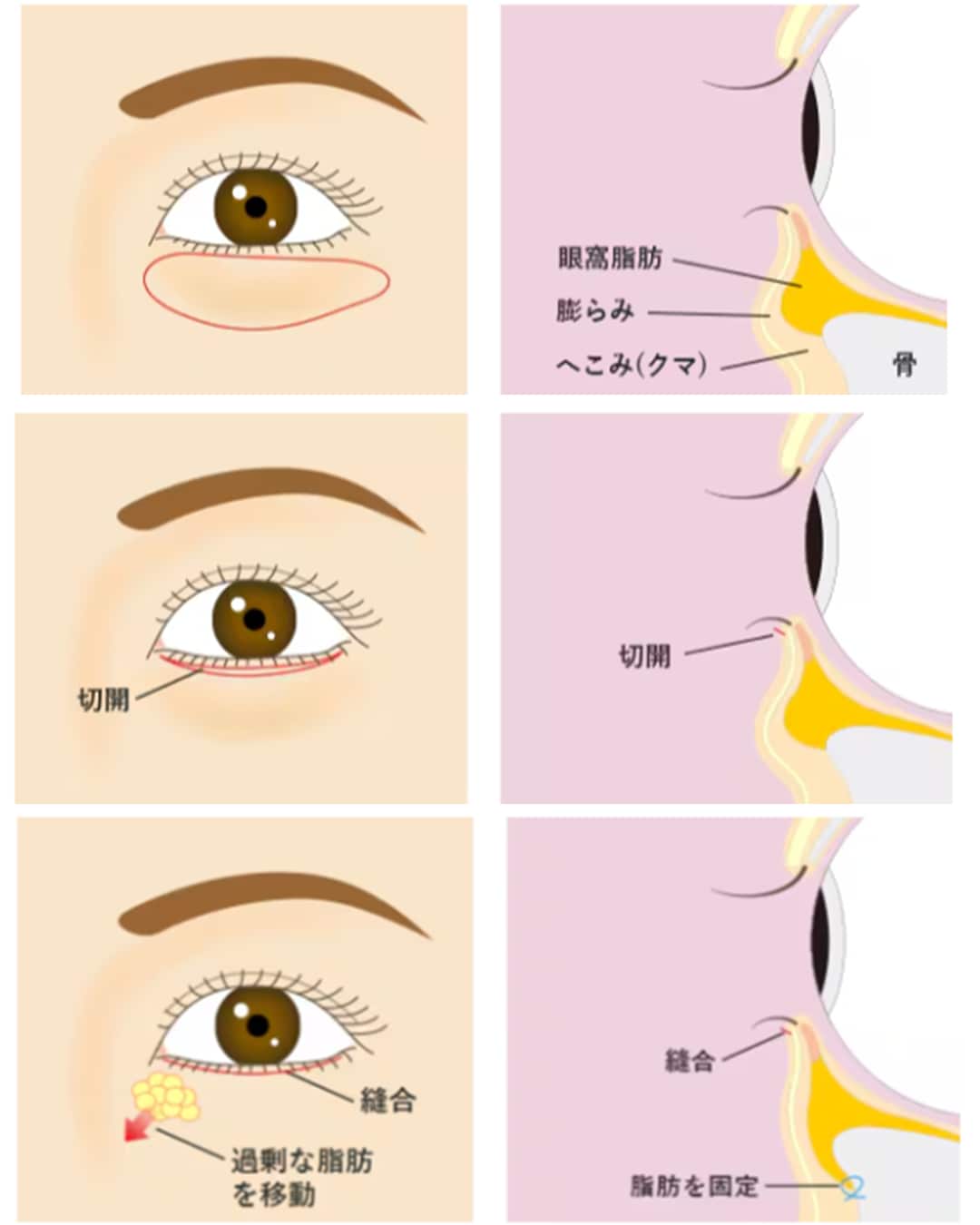 切開ハムラ