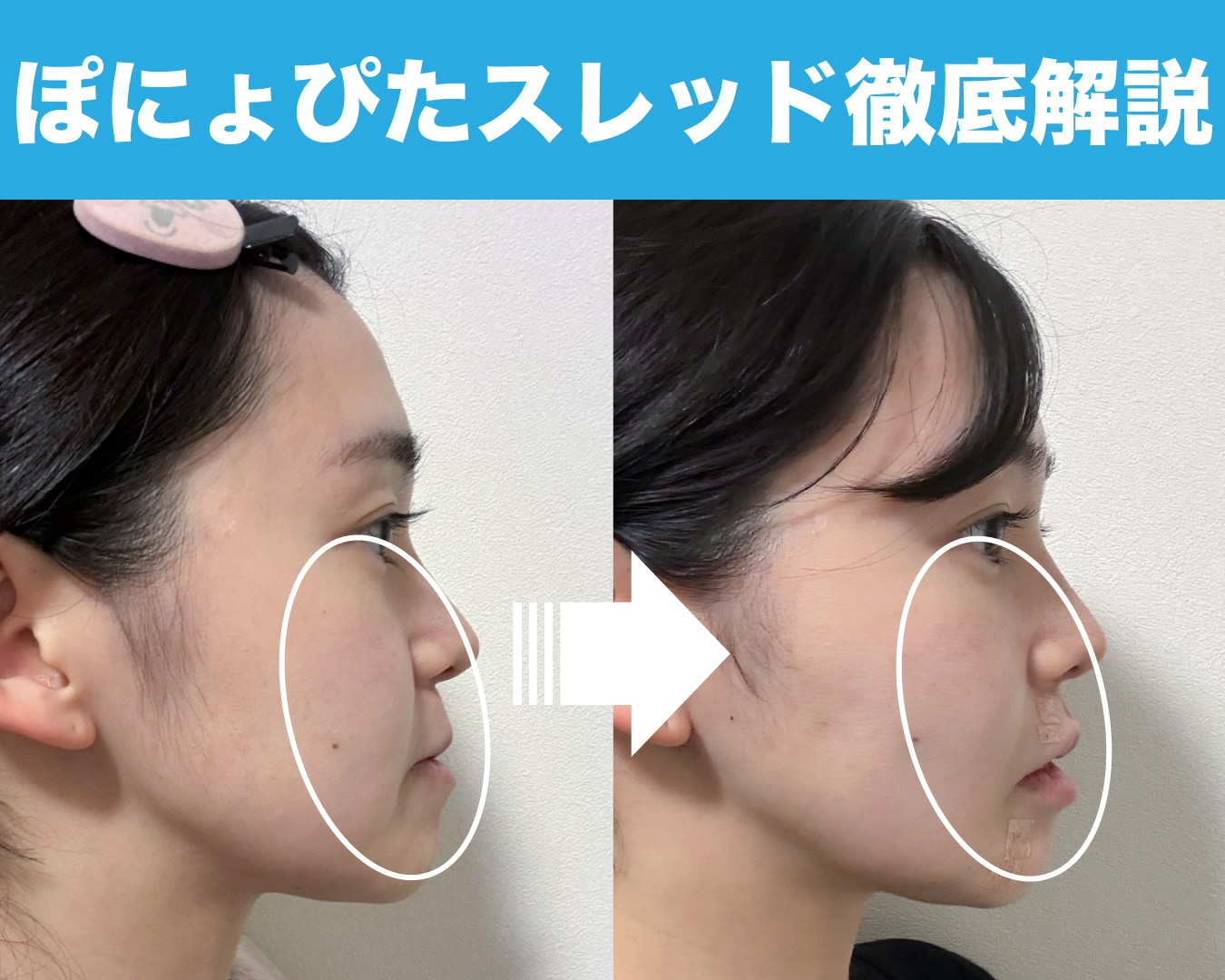 【新治療】口横のぽにょ・ほうれい線に「ぽにょぴたスレッド」