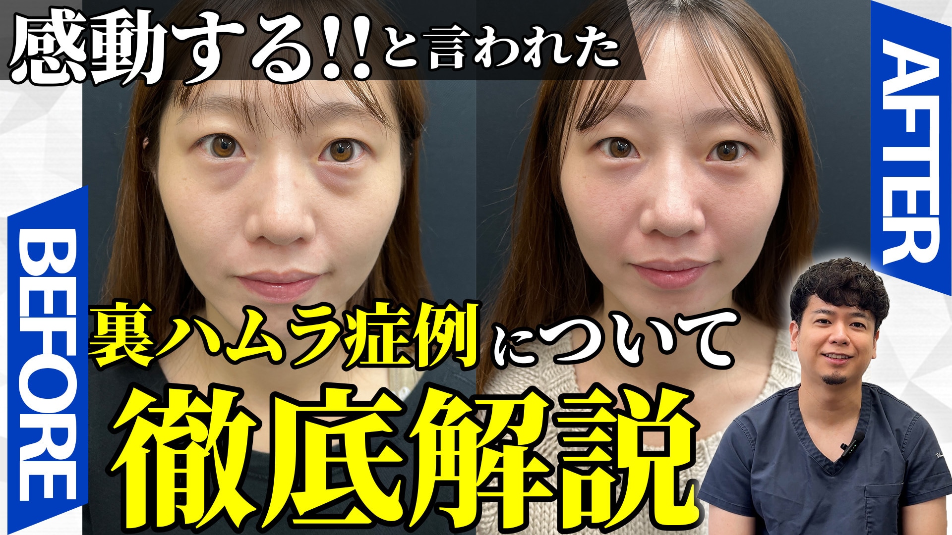 【アレン様も感動したクマ治療】裏ハムラの症例について解説