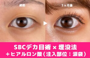 【目を大きくしたい方】デカ目術×涙袋のヒアルロン酸×埋没法