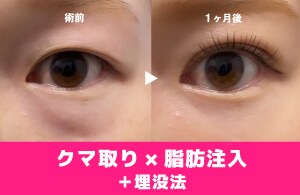 【若返りたい方】二重整形と一緒にクマ取りもしませんか?