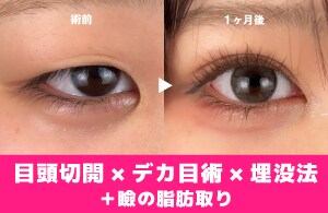 【究極の垢抜けたい方】目頭切開やデカ目などのフルコース!