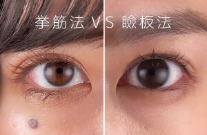 挙筋法と瞼板法について①