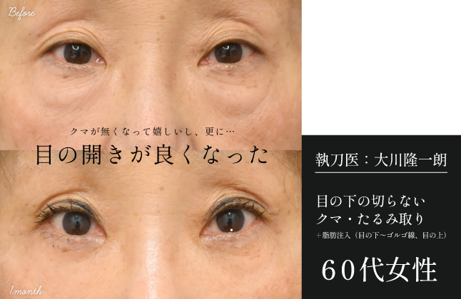 【60代女性】目の下の切らないクマ取り+脂肪注入